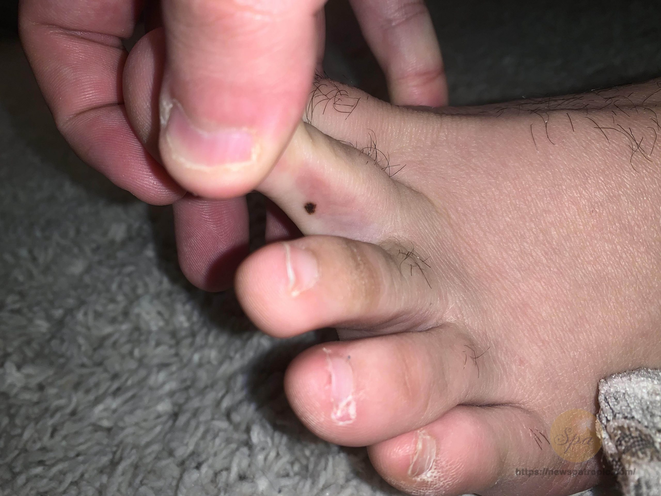 Nốt ruồi ở ngón chân